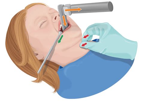 on many anesthesia machines, O2 is the driving pressure to compress the bellows. . Apex anesthesia